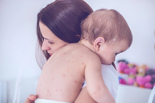 Image for article titled Chickenpox vaccination